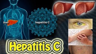 hepatitis c liver disease Harib Diagnostic Lab [upl. by Xineohp]