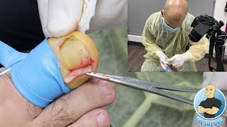 FIRST PERSON INGROWN TOENAIL REMOVAL [upl. by Gnourt]