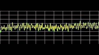 Rheumatoid Arthritis  Rife Frequencies [upl. by Alyt952]