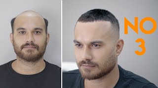 PROTEZ SAÇ  3 NUMARA SAÇ KESİMİ  Hair Replacement [upl. by Nazar]