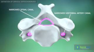 Cervical Osteochondrosis Definition [upl. by Ahseinet]