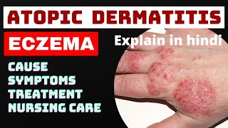 eczema  atopic dermatitis  in hindi  cause symptoms treatment nursing management skin disease [upl. by Aerdnak]