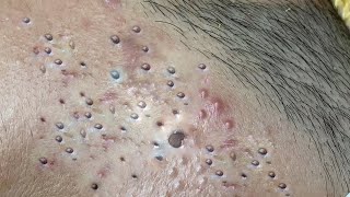 Big Cystic Acne Blackheads Extraction Blackheads amp Milia Whiteheads Removal Pimple Popping  5298 [upl. by Llyrpa]