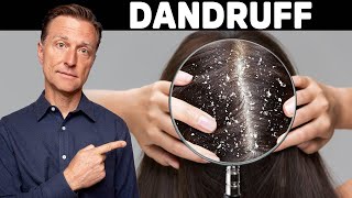 The REAL Cause and Cure for DANDRUFF [upl. by Katti361]