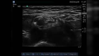 Ultrasound guided Intercostobrachial nerve block [upl. by Grefe]