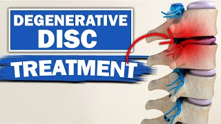 Degenerative Disc Disease Treatment amp 2 Best Exercises [upl. by Rozek]