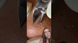 Blackheads Removal  Acne Treatment and Very Satisfying Satisfying Pimple pop blackheads [upl. by Shelly775]