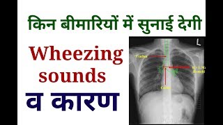 Wheezing Sounds  Causes OF wheezing Sounds  Lungs Examination [upl. by Aicertap589]