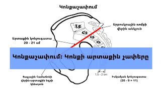 Կոնքաչափում Կոնքի արտաքին չափերը [upl. by Acirea]