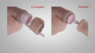 A comparison of Circumplast® and Plastibell® Circumcision Devices [upl. by Aliuqat]