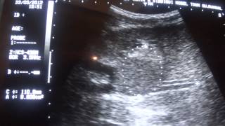 ultrasound  FOCAL MASS LESION in Lt Lobe of Liver [upl. by Alcock834]