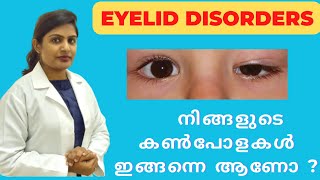 Eyelid disordersPtosis lagophthalmos SymblepharonEntropion  Know more about it [upl. by Amehsyt]