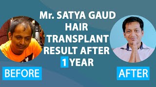 Mr SATYA GAUD HAIR TRANSPLANT RESULT AFTER ONE YEAR [upl. by Ahsyat]