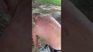 Bed bugs ate me up🤦‍♂️🤮😂 fyp viralvideo viral [upl. by Ahsinad]