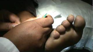 How to Remove difficult sutures [upl. by Sayre126]