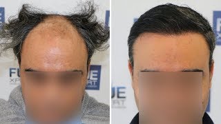 FUE Hair Transplant 3500 Grafts in NW V Dr Juan Couto  FUEXPERT CLINIC Madrid Spain [upl. by Teuton]