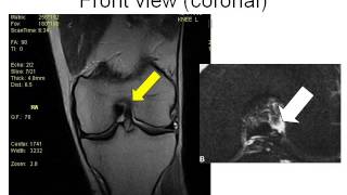 How to Read Knee MRI of ACL Tear  Torn ACL  Santa Fe Knee Specialist [upl. by Audette]