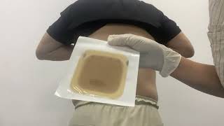 Hydrocolloid Wound Dressing [upl. by Airotkiv94]