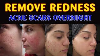 How to Remove Redness From Acne Scars  Remove Acne Marks With Home Remedies [upl. by Stannfield]