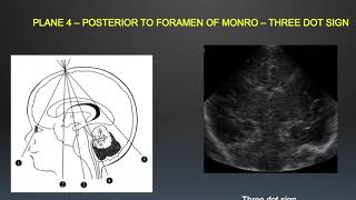 TMT Neurosono by Dr Mrudula Bapat  Basic Anatomy amp Scanning Technique [upl. by Aivekahs831]