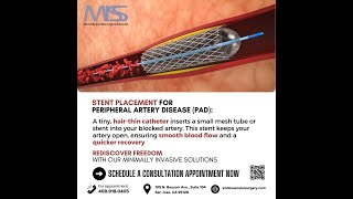 PAD Treatment Without Surgery Nonsurgical Stent Placement [upl. by Dweck]