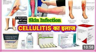 SKIN INFECTION  CELLULITIS सेलुुलायटिस का ईलाज कय है Drwakil ahmad MPT ortho [upl. by Holzman]