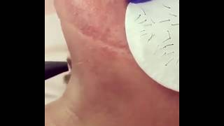 Permanent hair removal using Electrolysis [upl. by Yvonner]