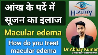 पर्दे में सूजन का इलाज  macular edema treatment  diabetic macular edema  healthyeyeofficial [upl. by Varuag]