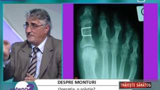 Totul despre monturi cu Dr PetreMihai Baleanu Foot Medical Hospital Roma ProEstetica Bucuresti [upl. by Shyamal]