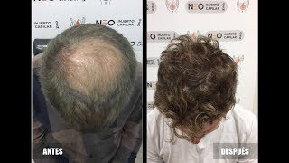 😱🇲🇽🔝INJERTO de CABELLO en MÉXICO  20 Cosas que no SABÍAS [upl. by Caia624]