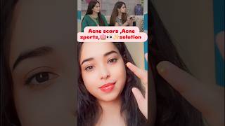 Acne scars acnescars acne acneremoval acnetreatment shorts beautytips skincare pimple short [upl. by Mcintyre]