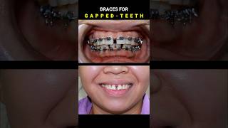 BRACES FOR GAPPED TEETH 32 MONTHS DURATION braces orthodontist dentist [upl. by Narayan]