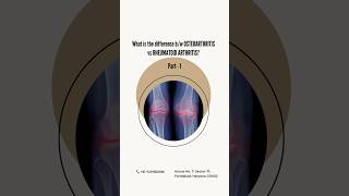 Osteoarthritis VS Rheumatoid Arthritis osteoarthritis rheumatoidarthritis physionearme [upl. by Aliuqat]