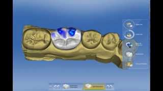 Sirona CEREC SW 40 Prozessübersicht Krone [upl. by Neyrb794]