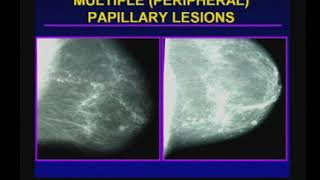 Management of Papillary Breast Lesions [upl. by Sherrer]