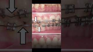 Dentist Reveal the Common Problems During Braces Treatment [upl. by Leisam755]