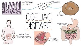 Celiac Disease Symptoms Diagnosis and Treatment CeliacDisease MedicalStudents Gastroenterology [upl. by Imorej]