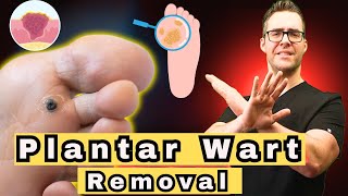 How To Get Rid of the MOST STUBBORN Plantar Warts 2024 Update [upl. by Ymia955]