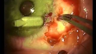 Dr Laurence Sullivan Recurrent pterygium over Intralase LASIK flap edgewmv [upl. by Ylek]