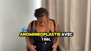 Témoignage d’une patiente satisfaite par sa liposuccion avec abdominoplastie et bbl avec SERVIHEALTH [upl. by Zelde378]