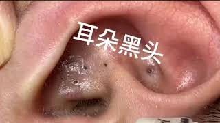 Blackheads in giant ears  Follow the process of acne surgery [upl. by Justin]