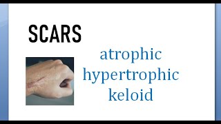 Surgery 015 Scars Atrophic hypertrophic keloid difference compare between vs wound [upl. by Arraeic179]