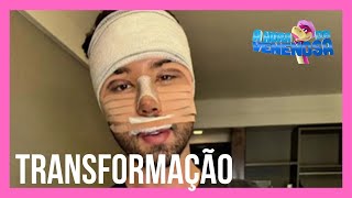 Rico Melquiades faz cirurgia para transformar o rosto após ser chamado de feio [upl. by Ennovart509]