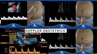 TECNICA DOPPLER OBSTETRICO BASICO [upl. by Oicul848]