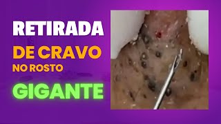 Cravos pretos profundos e gigantes  Tirando cravos e EspinhasVIDEO SATISFATÓRIO E RELAXANTE 02 [upl. by Reffotsirhc]