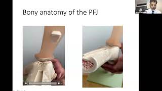 September 2020 Patellar Instability Surgical and Conservative Management Options [upl. by Enaffit]