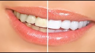 Beauty Tips  Simple steps for at home Teeth Whitening  Beauty Tips [upl. by Rorry]