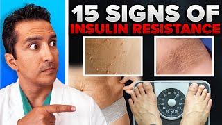 15 Signs Of Insulin Resistance You Should Look Out [upl. by Siraved]