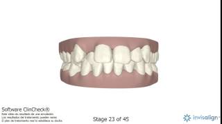 ClinCheck Invisalign® 5 [upl. by Saidee]