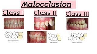 malocclusionsClass IClass IIClass IIIClinical featuresQuick Revision [upl. by Nomelihp652]